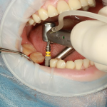 Image 1 of 2 Key Pointers to be Aware of as You Consider Dental Implants