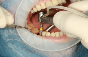 Image 1 of 2 Key Pointers to be Aware of as You Consider Dental Implants